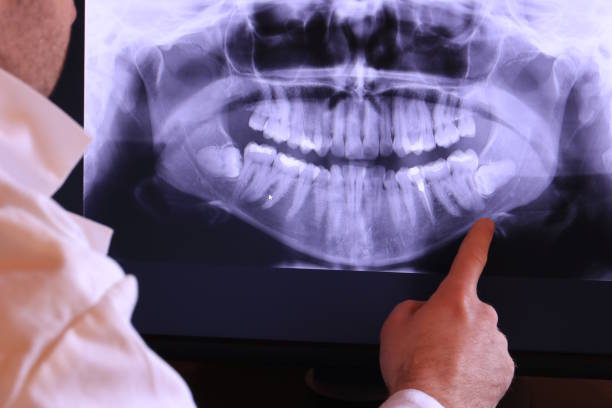 Best Emergency Dentist for Lost Fillings or Crowns in Phoenix, NY